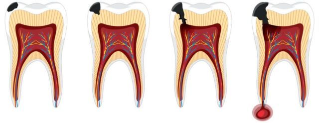 Nieleczona próchnica może prowadzić nawet do utraty zęba.